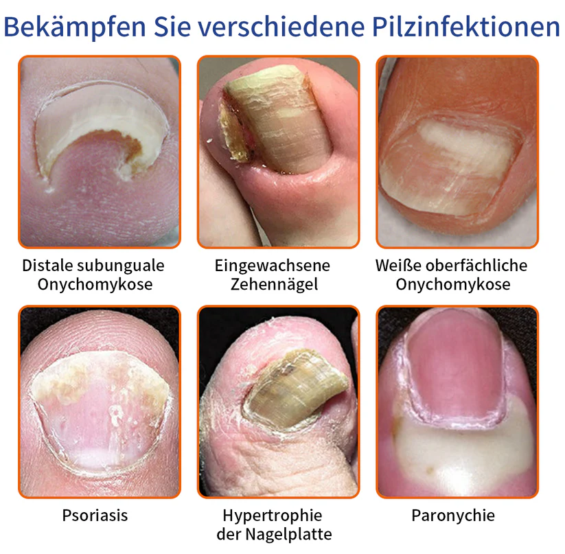 🐝🐝Solución para el tratamiento de hongos en las uñas con veneno de abeja Furzero™: resuelva completamente el problema de los hongos en las uñas🌟👣