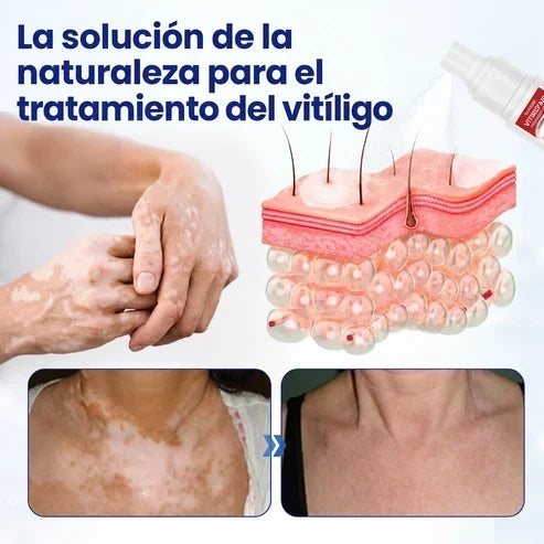 VitiRepair - Spray avanzado para el vitiligo y parches blancos