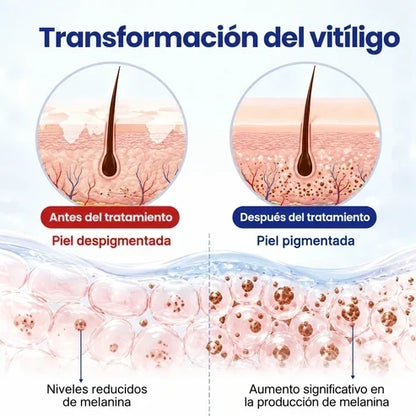 VitiRepair - Spray avanzado para el vitiligo y parches blancos