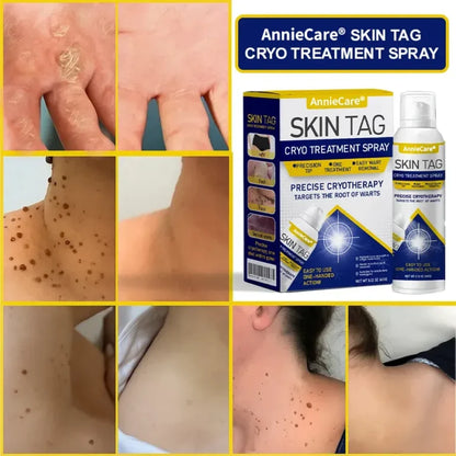 AnnieCare® Spray de crioterapia para verrugas cutáneas
