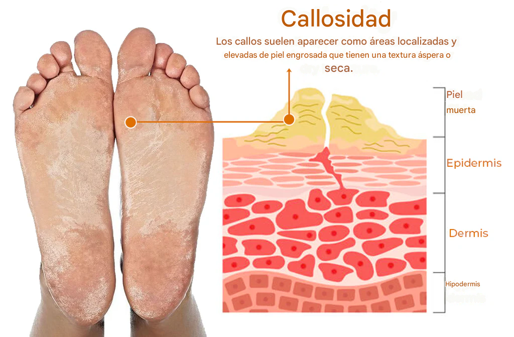 Aerosol para eliminar callos de los pies Croaie™