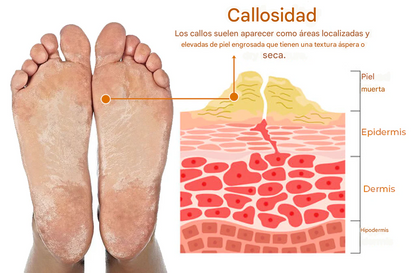 Aerosol para eliminar callos de los pies Croaie™